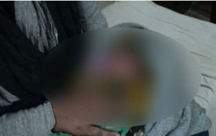 আয়া দিয়ে প্রসূতির সিজার, কেটে ফেলা হল নবজাতকের কপাল!