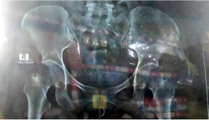 প্রসূতির জরায়ুতে সুই রেখেই সেলাই!