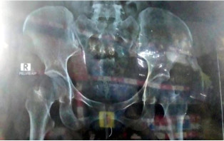 প্রসূতির জরায়ুতে সুই রেখেই সেলাই!