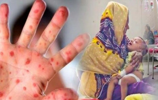 গত ২৪ ঘণ্টায় হামের উপসর্গ নিয়ে দেশে আরও ১১ শিশুর মৃত্যু